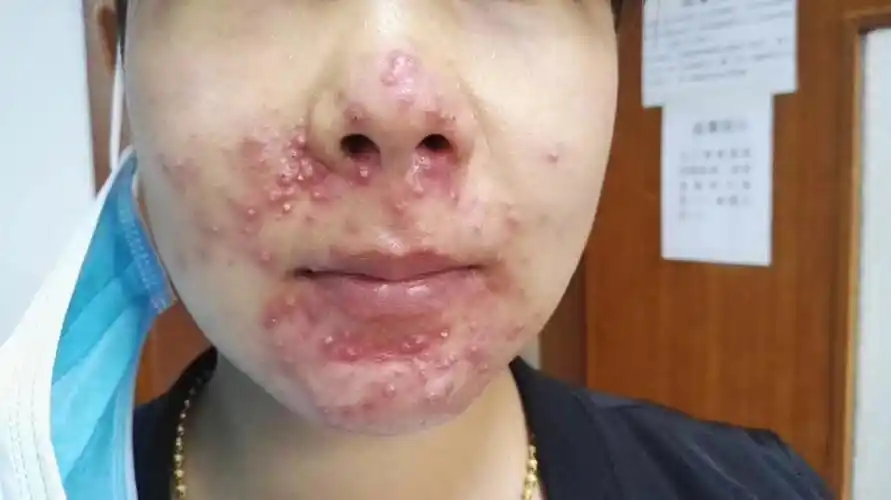 性质及严重程度可将痤疮分为三度,四级:1级(轻度):仅有粉刺2级(中度)