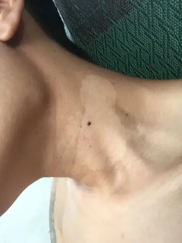 希望一个专业的医务人员给予我答案,我脖子上这是怎么了,好几年了