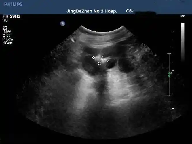 怀疑肾积水,找到结石就结束了吗?_肾盂