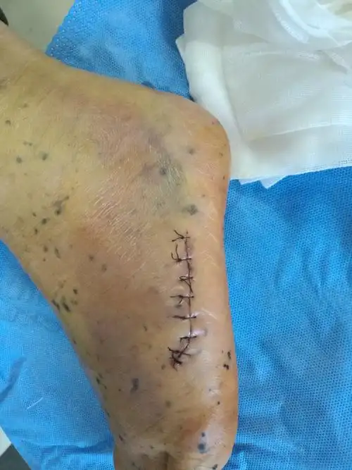 关于出院后换药拆线复查