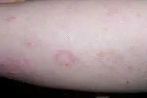 头皮牛皮癣症状图片_银屑病求医网