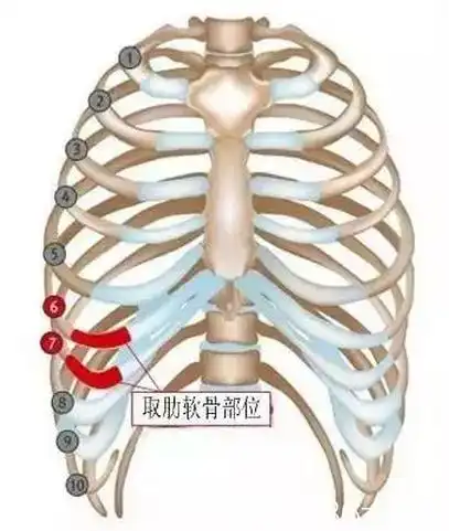 因为:自体软骨——隆鼻,适用于鼻尖低塌,鼻小柱短小,鼻梁局部凹陷偏低