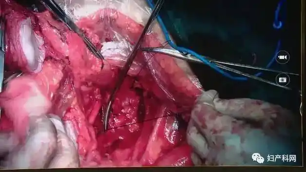 吴小华教授术式:外阴癌(外阴广泛性切除 单