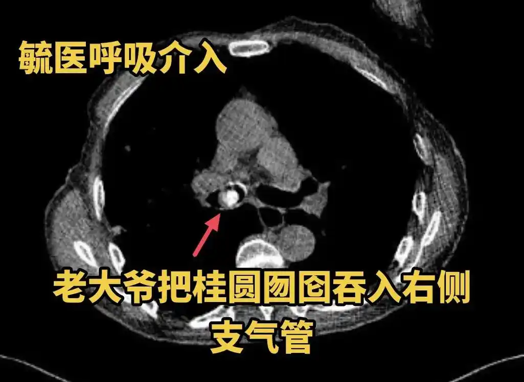 江湖救急之异物取出.