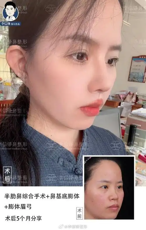 【面中部凹陷案例】来自广西,鼻子典型低鼻,面中部凹陷,朝天,鼻头圆钝