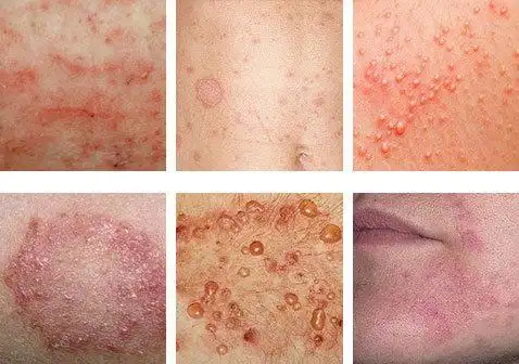 皮肤病的原因是什么造成的图片