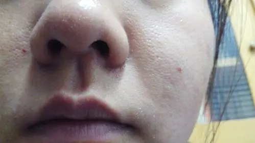 我想问一下我这属于什么原因形成的毛孔粗大?是缺水还是老化?