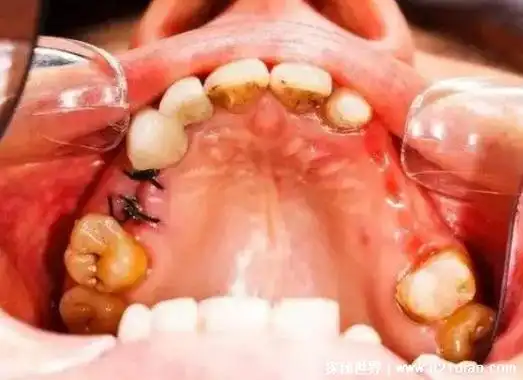 一次拔两颗智齿后悔死了,有人拔牙之后得了干槽症痛不欲生-热点-奇诺