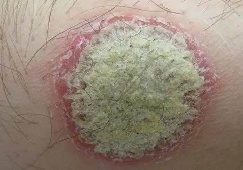 银屑病斑块样子图片