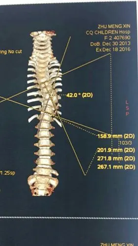 2岁1个月患儿,胸7半椎体