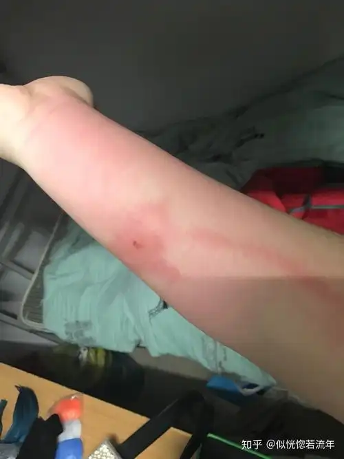 被虫子咬了,胳膊上一条红线往上延伸,这是什么? - 知乎