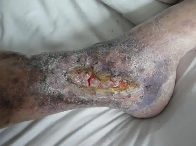 下肢溃疡(下肢溃疡的鉴别诊断)