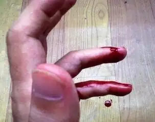 血小板偏低的危害