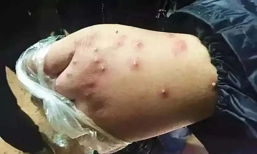 被红火蚁咬伤的手毛毛虫,防不胜防的毒毛蝴蝶很美,但变蝴蝶之前的毛