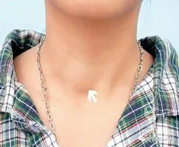 甲状腺不好,脖子先知!警告:颈部出现这3种症状,有可能是甲状腺癌_淋巴