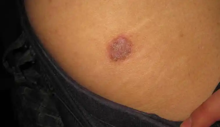 你知道什么是钱币湿疹吗