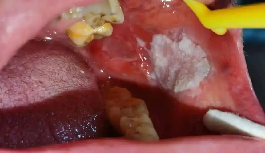 白白软软的没啥感觉 这种癌前病变要当心!_口腔_浙江省_黏膜