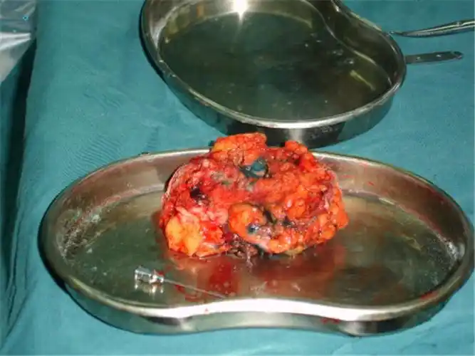 成功切除的乳腺癌图片