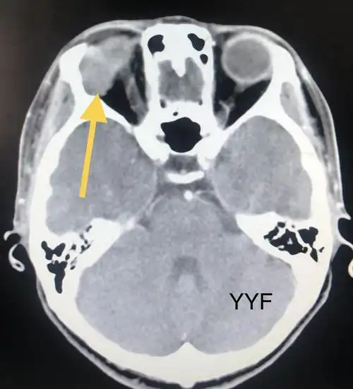 泪腺混合瘤_泪腺混合瘤治疗方式 - 好大夫在