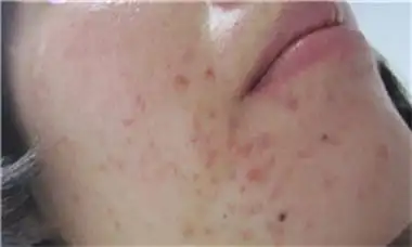 丘疹型痘痘图片