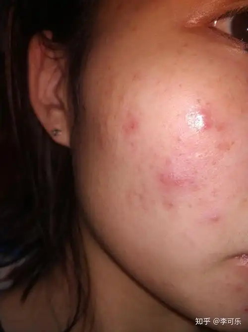 中度痤疮服用异维a酸胶囊记录