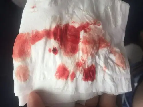 今天我大便完,就看见纸巾上有血!