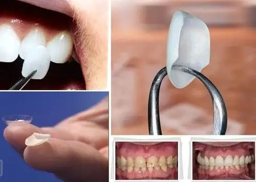 瓷贴面--给牙齿微整形_牙齿修复-德一口腔