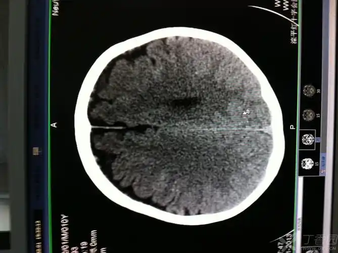 片子 额顶叶是怎么回事