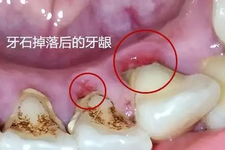 牙齿掉了一小块怎么办