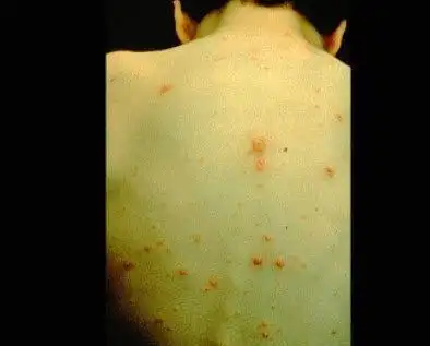 单纯疱疹病毒感染症