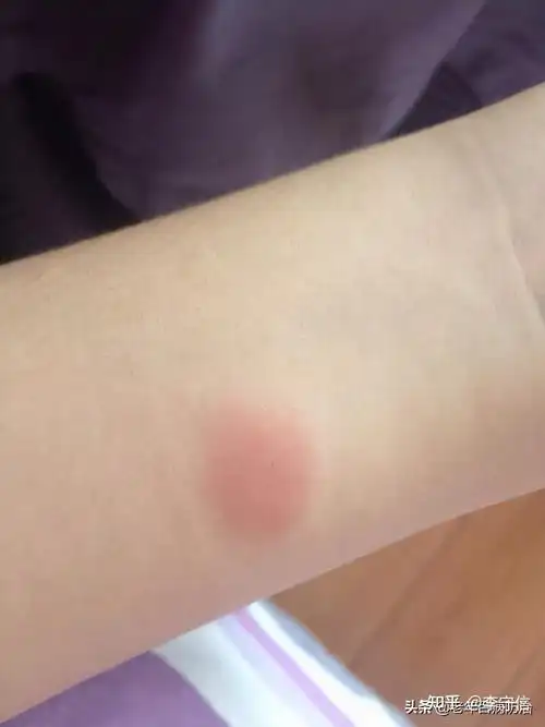 肺结核要怎么筛查