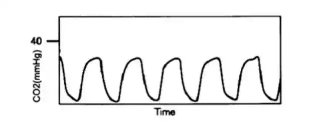 教你如何解读呼气末二氧化碳波形