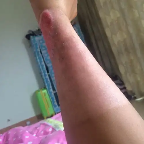 我是做工地的 上班时间被乙炔烧伤 现在胳膊落疤痕 应该怎么赔偿