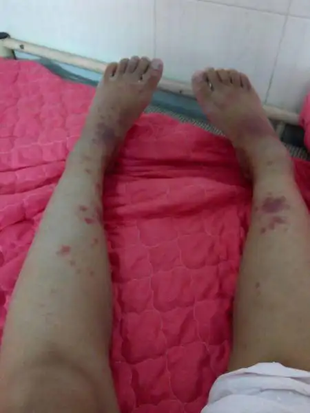 想请问一下这个是什么?很痒而且像是蚊子咬的,差不多一个礼拜了