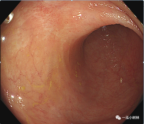 肠道病变内镜图片