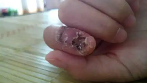 在厂里上班,上班的时候手被风扇打伤了,指甲已经没了