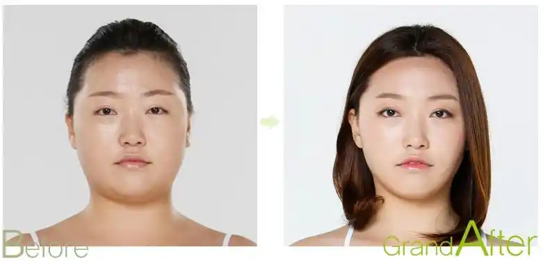 韩国高兰得医院面部激光溶脂前后对比照片