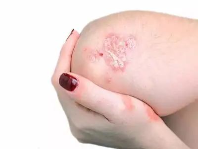 银屑病症状图片_银屑病求医网