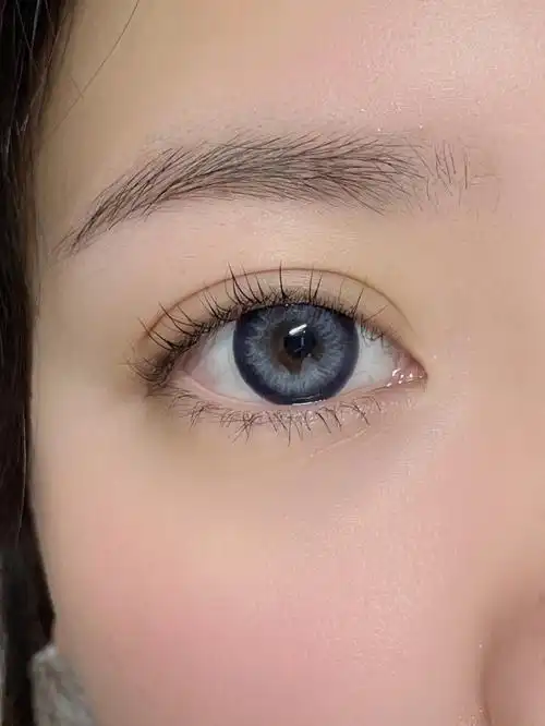 大直径虹膜混血