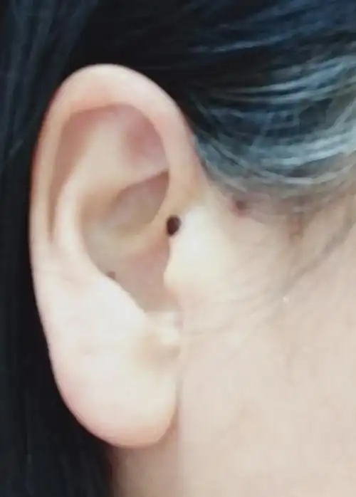 我点掉了穷鬼痣