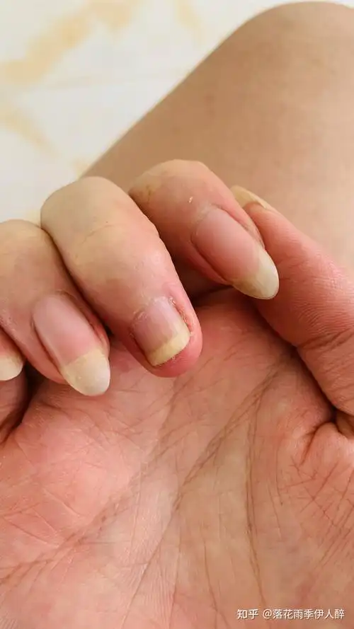 指甲 甲肉分离 - 知乎