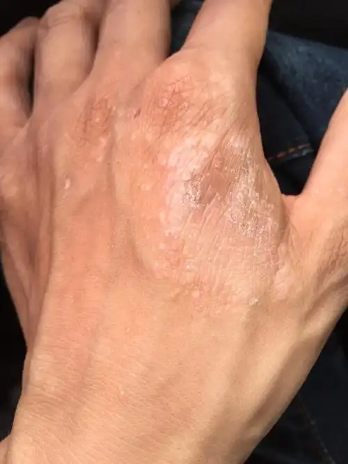 手背有脱皮 偶尔还痒 最近半年才有的 以前从没有过.这是什么情况 怎