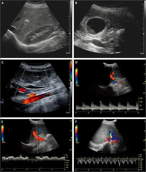 1. 腹部超声影像