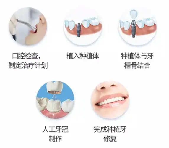 种植方案,整个过程只需5步,包括3d导报精准植入牙体,3d打印牙冠等步骤