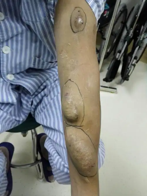 留置过中心静脉导管,是什么原因导致锁骨下静脉-腋静脉交界处狭窄呢?