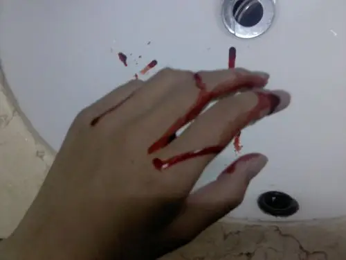 伤口愈合吃什么好的快 轻微刀伤图片大