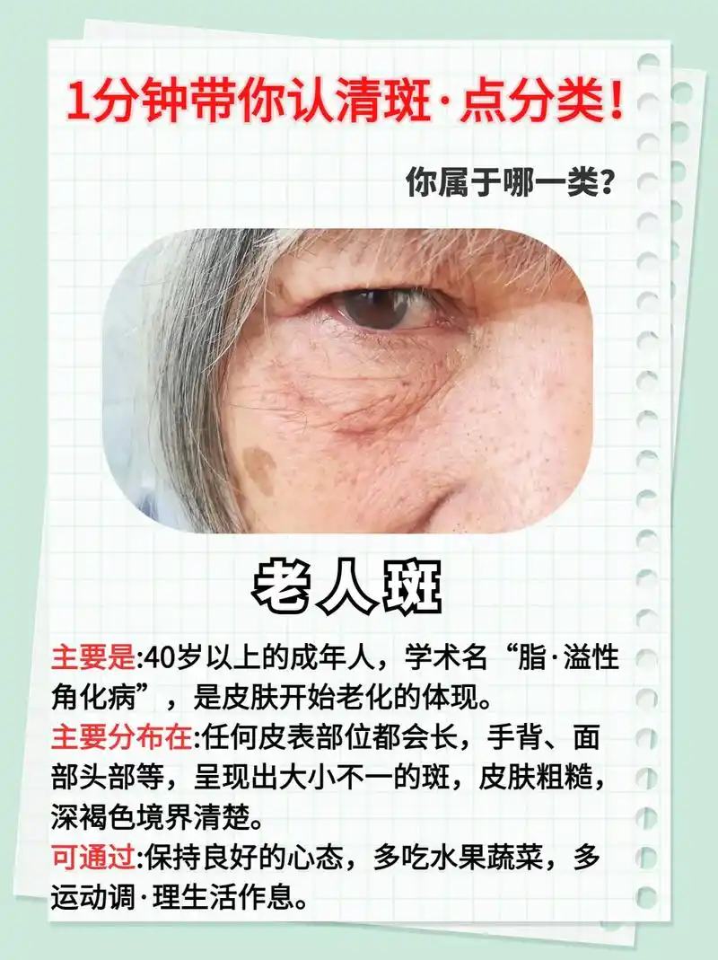 1分钟带你认清斑·点分类.斑·点是我们容易忽略的身体信号,但 - 抖音
