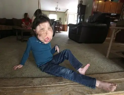 美9岁巨脑女童病情罕见成医学界未解之谜 - 中国日报网