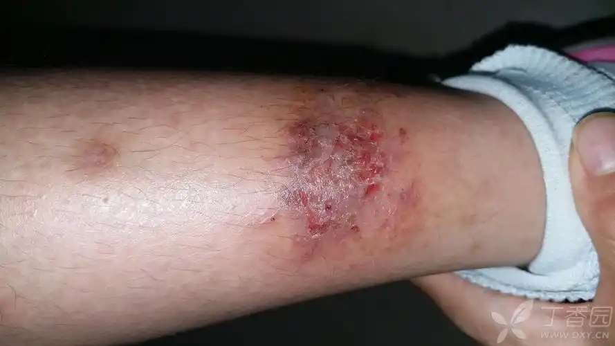 过敏性湿疹合并溃烂,怎么办