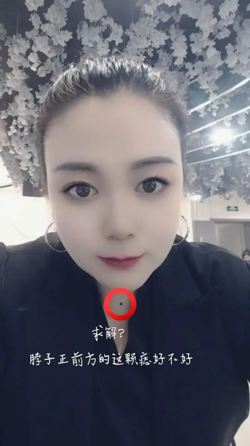 求解:脖子正前方的这颗痣到底好不好? - 抖音